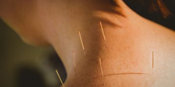 Was ist Dry Needling und Wie lange dauert eine Dry Needling-Behandlung?